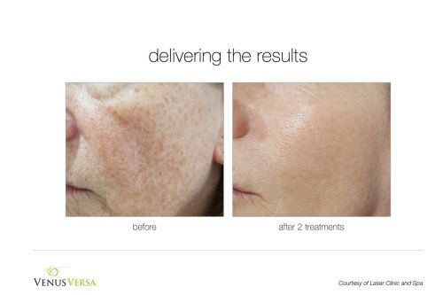 venus versa photofacial at skin space